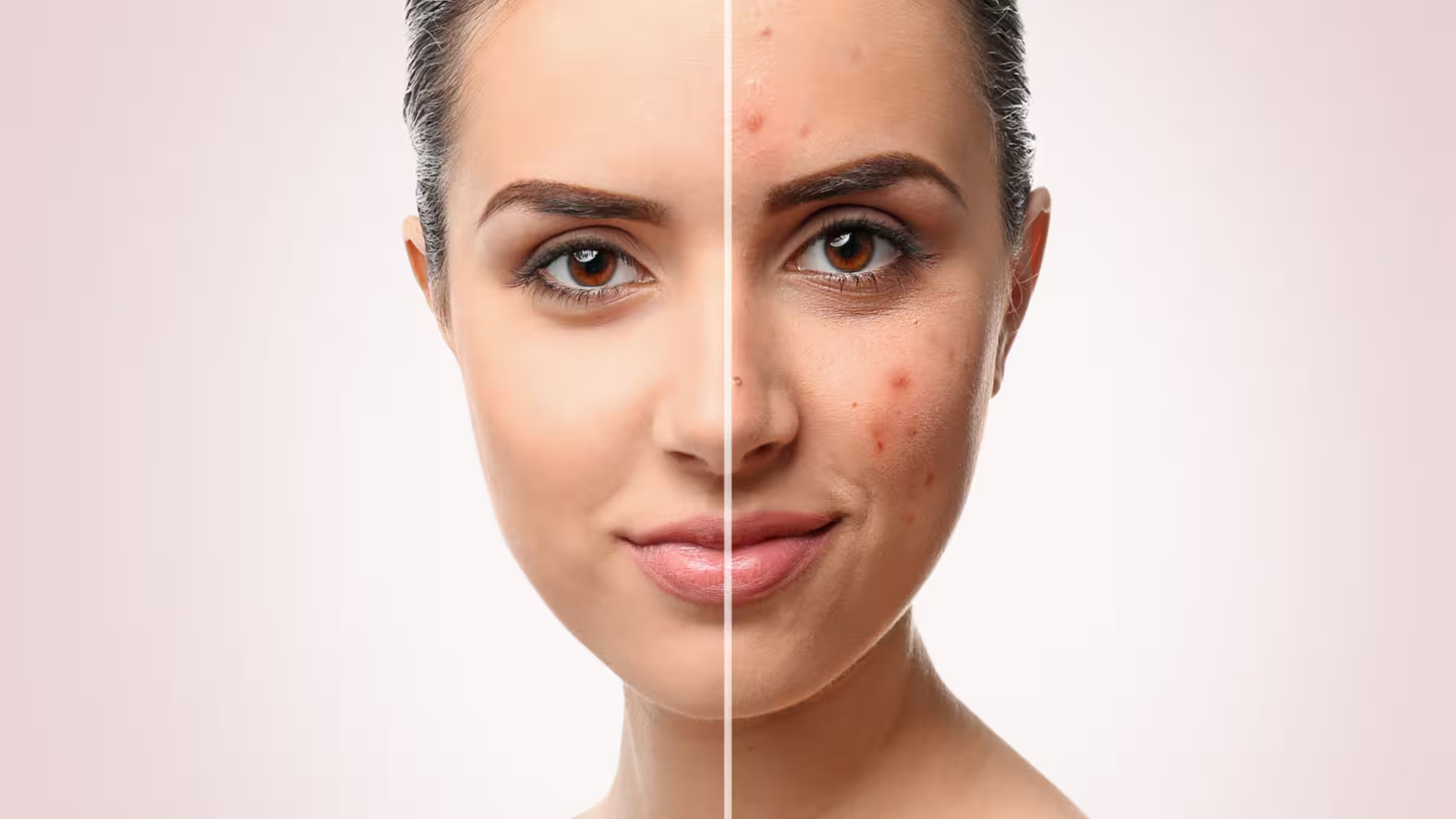 Acne treatment before and after, Modern Aestheticss Dubai