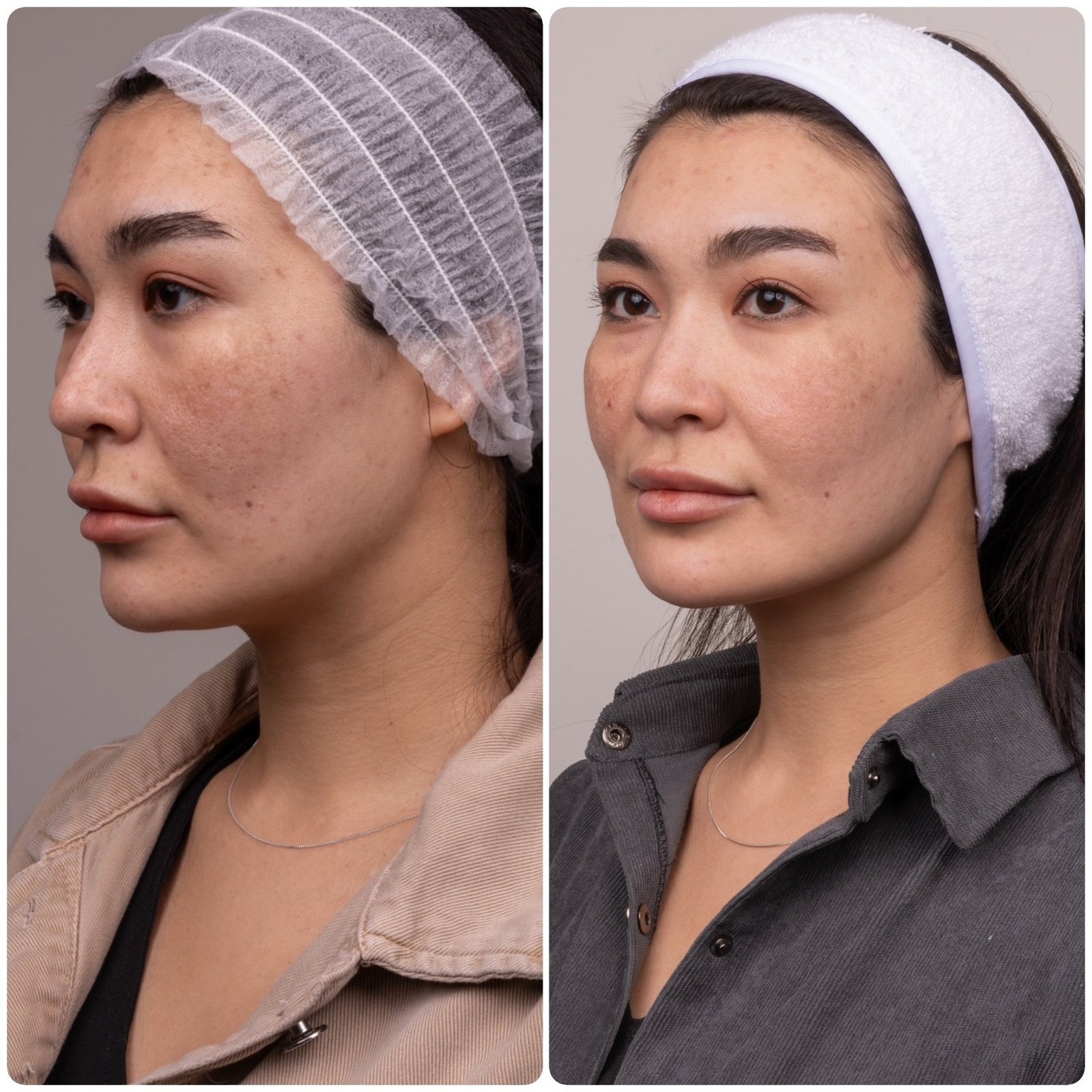 HIFU patient before and after, three-quarter angle left