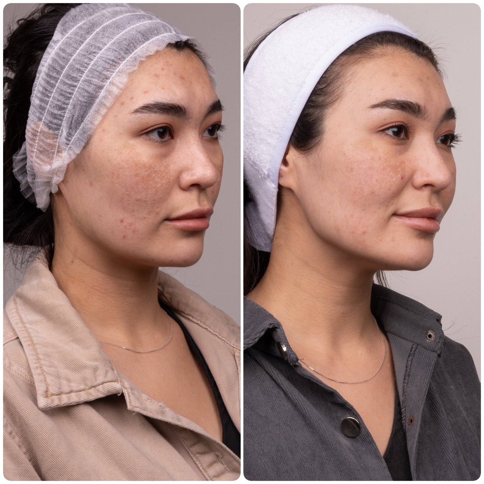 HIFU patient before and after, three-quarter angle right