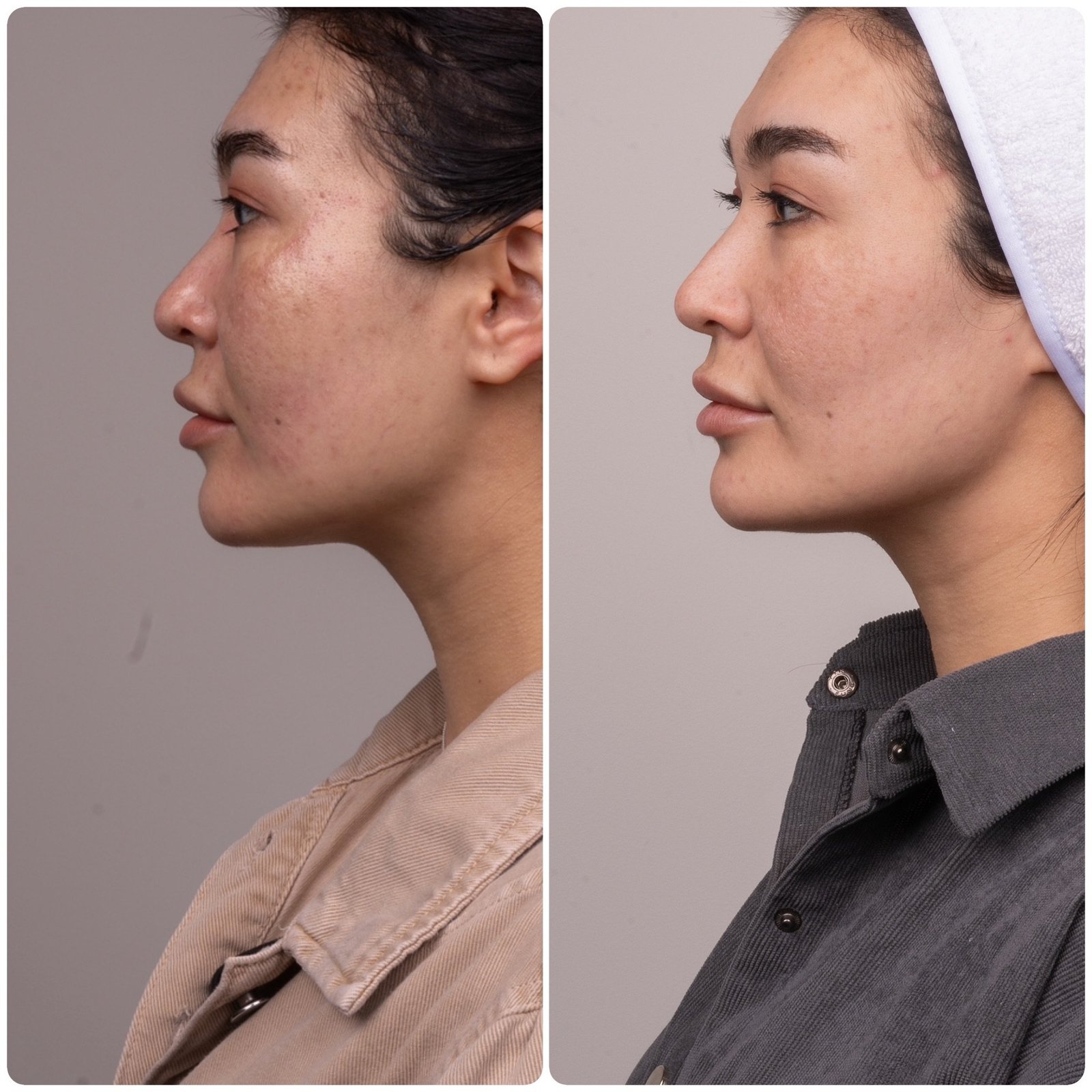 HIFU patient before and after, side profile