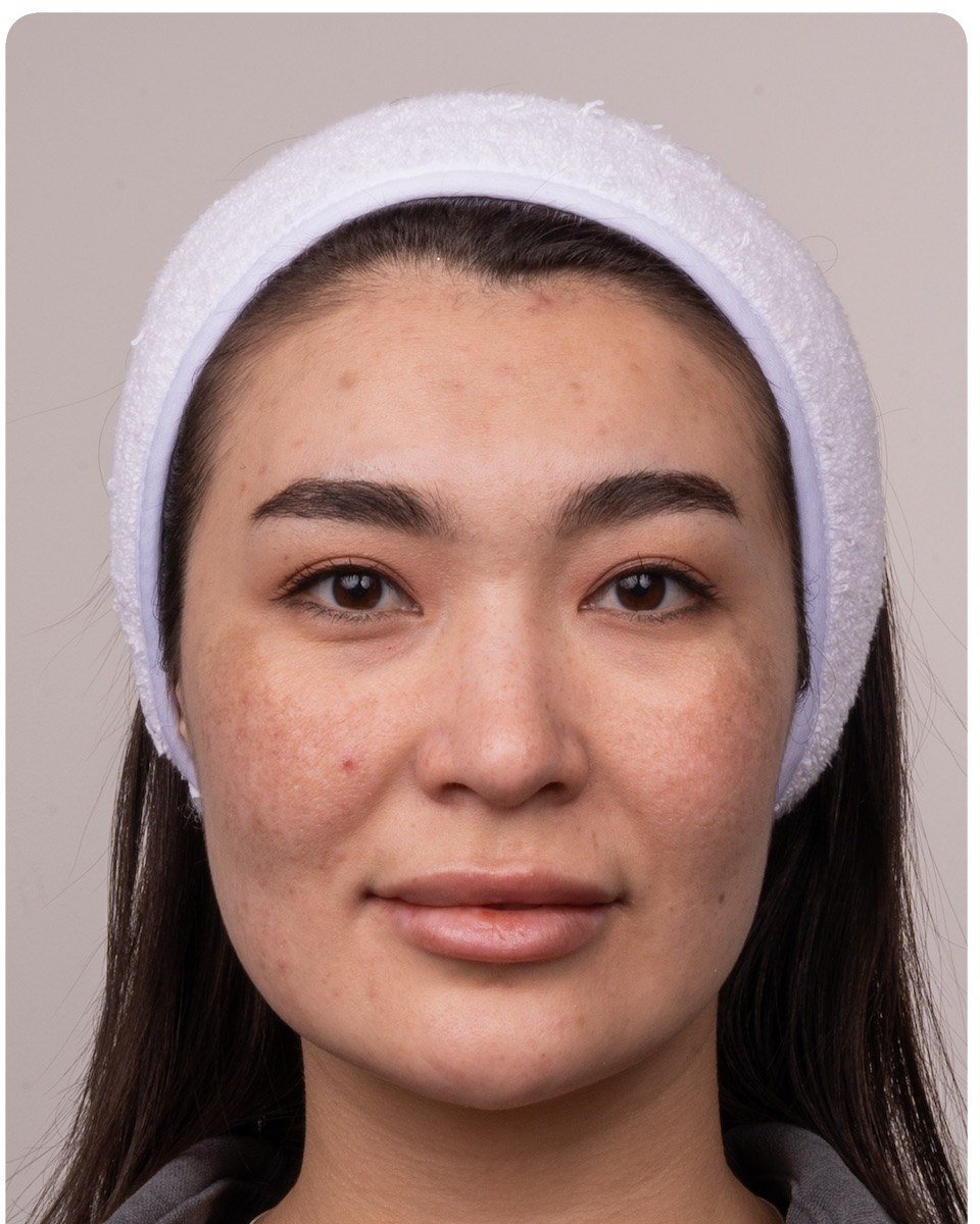 HIFU patient after treatment, Modern Aestheticss Dubai