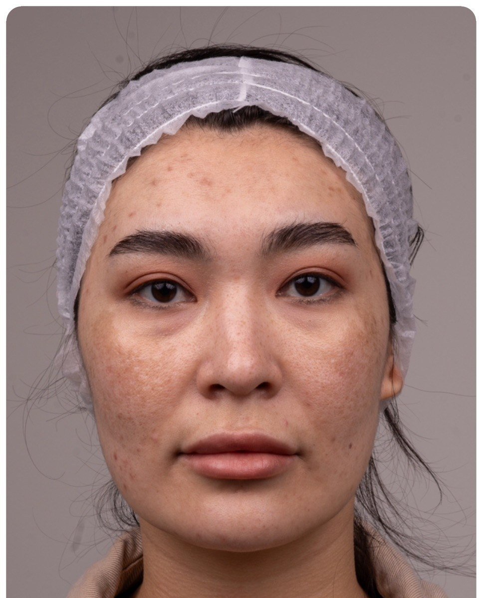 HIFU patient before treatment, Modern Aestheticss Dubai