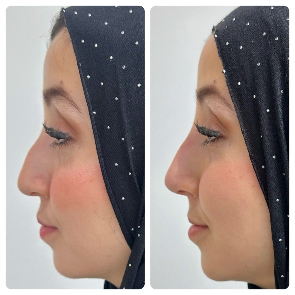 PDO nose thread lift before and after