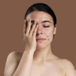 Acne Treatment