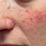 rosacea-symptoms-and-causes