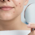 Are Whiteheads, Blackheads, Zits, and Pimples the Same Thing? Let’s Clear the Confusion! - Main Image