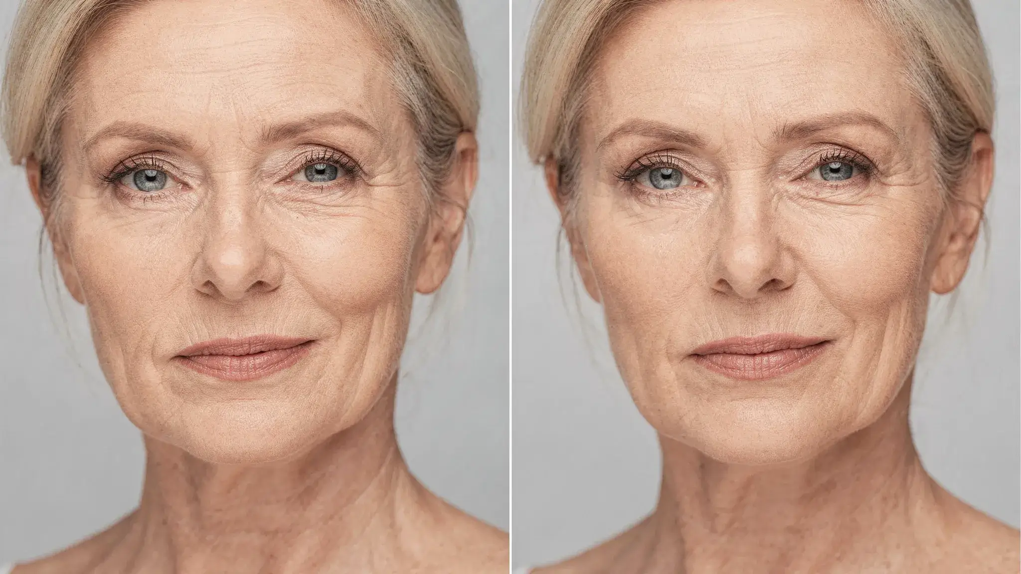 Before and after concept image showing the same middle-aged woman: left side with mild jowling and fine lines, right side after treatment with a cleaner jawline, softened crow’s feet, and brighter skin tone, photographed in neutral light.