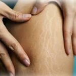 stretch mark