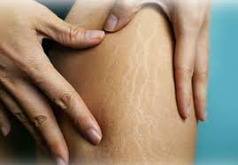 stretch mark