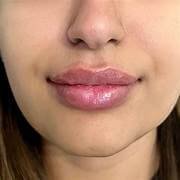 Hyaluronidase Filler Dissolving in Dubai