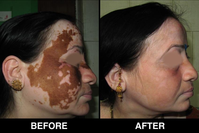 vitiligo before and after