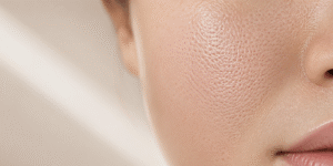 Best Treatment for Pores on Face