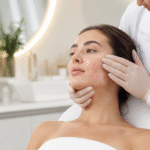 Advanced Acne Treatment in Dubai