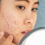 Acne on Cheeks