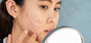 Acne on Cheeks