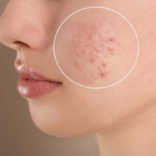 acne-causes-img